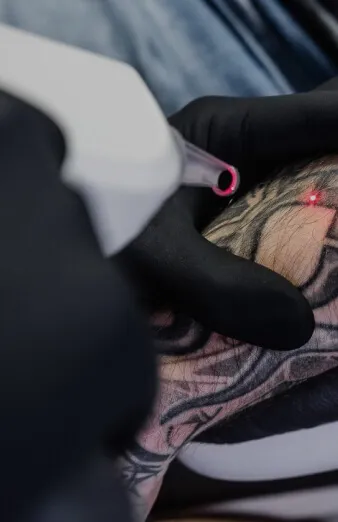 Dermal Anchor